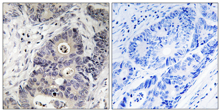 NOS2 / iNOS Antibody - Immunohistochemistry analysis of paraffin-embedded human colon carcinoma, using iNOS (Phospho-Tyr151) Antibody. The picture on the right is blocked with the phospho peptide.