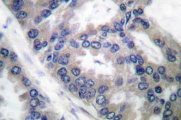 NOS2 / iNOS Antibody - IHC of iNOS (V1131) pAb in paraffin-embedded human lung carcinoma tissue.