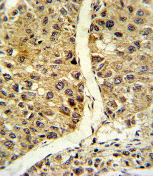 NOS3 / eNOS Antibody - Formalin-fixed and paraffin-embedded human hepatocarcinoma reacted with NOS3 Antibody , which was peroxidase-conjugated to the secondary antibody, followed by DAB staining. This data demonstrates the use of this antibody for immunohistochemistry; clinical relevance has not been evaluated.