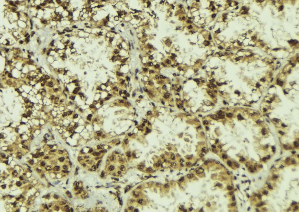 NOT1 / CNOT1 Antibody - 1:100 staining human lung tissue by IHC-P. The sample was formaldehyde fixed and a heat mediated antigen retrieval step in citrate buffer was performed. The sample was then blocked and incubated with the antibody for 1.5 hours at 22°C. An HRP conjugated goat anti-rabbit antibody was used as the secondary.