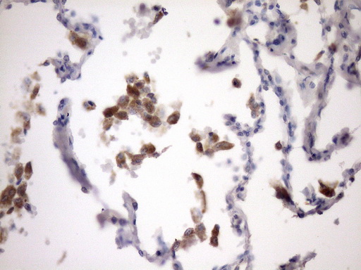 NOTCH1 Antibody - Immunohistochemical staining of paraffin-embedded Carcinoma of Human lung tissue using anti-NOTCH1 mouse monoclonal antibody. (Heat-induced epitope retrieval by Tris-EDTA, pH8.0)(1:150)