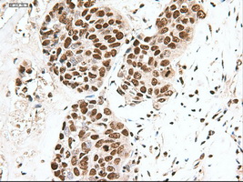 NOTCH1 Antibody - IHC of paraffin-embedded Adenocarcinoma of breast using anti-Notch1 mouse monoclonal antibody.