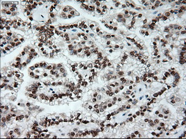 NOTCH1 Antibody - IHC of paraffin-embedded Carcinoma of kidney using anti-Notch1 mouse monoclonal antibody.