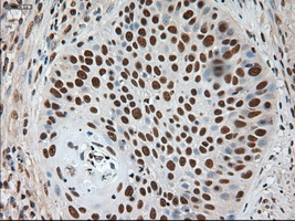 NOTCH1 Antibody - IHC of paraffin-embedded Carcinoma of lung using anti-Notch1 mouse monoclonal antibody.