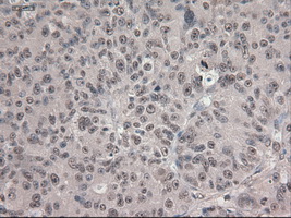 NOTCH1 Antibody - IHC of paraffin-embedded Adenocarcinoma of ovary using anti-Notch1 mouse monoclonal antibody.