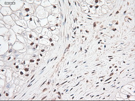 NOTCH1 Antibody - IHC of paraffin-embedded Carcinoma of pancreas using anti-Notch1 mouse monoclonal antibody.
