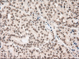 NOTCH1 Antibody - IHC of paraffin-embedded Carcinoma of thyroid using anti-Notch1 mouse monoclonal antibody.