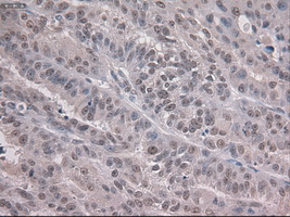 NOTCH1 Antibody - IHC of paraffin-embedded Adenocarcinoma of ovary tissue using anti-NOTCH1 mouse monoclonal antibody. (Dilution 1:50).