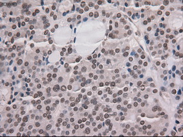 NOTCH1 Antibody - IHC of paraffin-embedded Carcinoma of thyroid tissue using anti-NOTCH1 mouse monoclonal antibody. (Dilution 1:50).