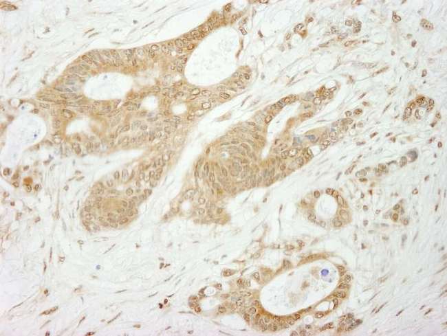 NOTCH1 Antibody - Detection of Human Notch1Immunohistochemistry. Sample: FFPE section of human ovarian carcinoma. Antibody: Affinity purified rabbit anti-Notch1 used at a dilution of 1:250.