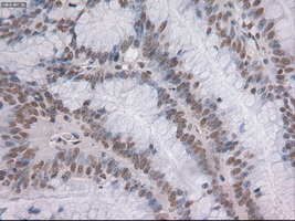 NOTCH1 Antibody - IHC of paraffin-embedded Adenocarcinoma of colon tissue using anti-NOTCH1 mouse monoclonal antibody. (Dilution 1:50).