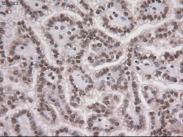NOTCH1 Antibody - IHC of paraffin-embedded Carcinoma of kidney tissue using anti-NOTCH1 mouse monoclonal antibody. (Dilution 1:50).