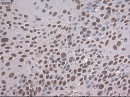 NOTCH1 Antibody - IHC of paraffin-embedded Carcinoma of lung tissue using anti-NOTCH1 mouse monoclonal antibody. (Dilution 1:50).