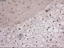 NOTCH1 Antibody - IHC of paraffin-embedded Carcinoma of pancreas tissue using anti-NOTCH1 mouse monoclonal antibody. (Dilution 1:50).
