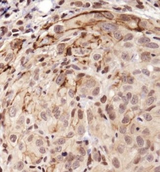 NOTCH1 Antibody - Immunohistochemistry: Notch1 Antibody - IHC of Notch1 in human kidney carcinoma using DAB with hematoxylin counterstain.  This image was taken for the unconjugated form of this product. Other forms have not been tested.
