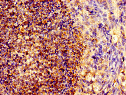 NOTCH1 Antibody - Immunohistochemistry image of paraffin-embedded human ovarian cancer at a dilution of 1:100