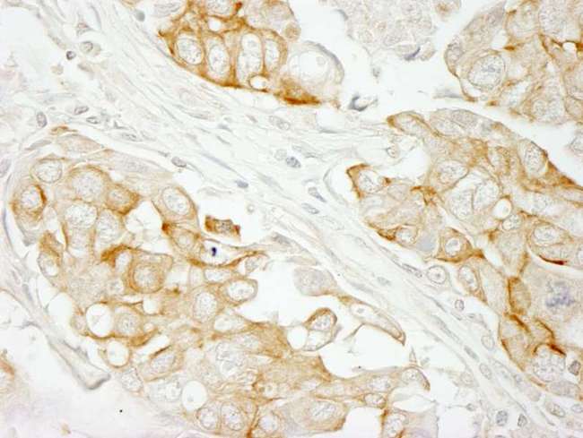NOTCH2 Antibody - Detection of Human Notch2 Immunohistochemistry. Sample: FFPE section of human breast carcinoma. Antibody: Affinity purified rabbit anti-Notch2 used at a dilution of 1:250.