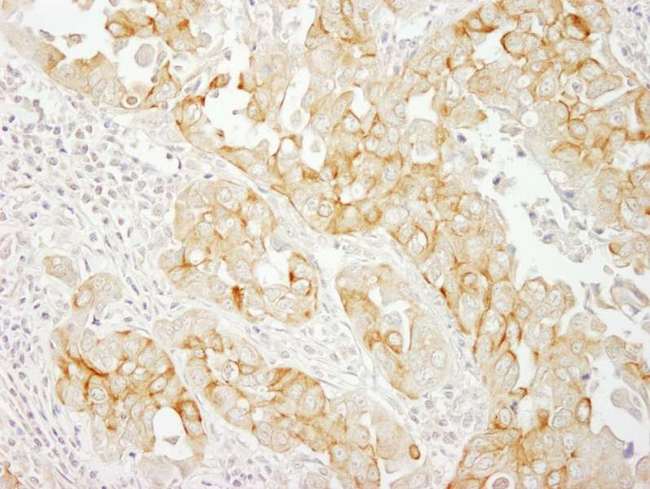 NOTCH2 Antibody - Detection of Human Notch2 by Immunohistochemistry. Sample: FFPE section of human breast carcinoma. Antibody: Affinity purified rabbit anti-Notch2 used at a dilution of 1:200 (1 ug/ml). Detection: DAB.