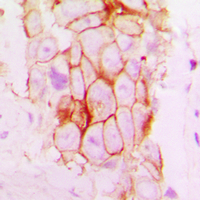 NOTCH2 Antibody - Immunohistochemical analysis of NOTCH2 staining in human breast cancer formalin fixed paraffin embedded tissue section. The section was pre-treated using heat mediated antigen retrieval with sodium citrate buffer (pH 6.0). The section was then incubated with the antibody at room temperature and detected using an HRP conjugated compact polymer system. DAB was used as the chromogen. The section was then counterstained with hematoxylin and mounted with DPX.