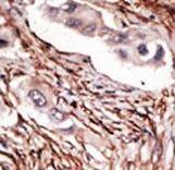 NOTCH3 Antibody - Formalin-fixed and paraffin-embedded human cancer tissue reacted with the primary antibody, which was peroxidase-conjugated to the secondary antibody, followed by DAB staining. This data demonstrates the use of this antibody for immunohistochemistry; clinical relevance has not been evaluated. BC = breast carcinoma; HC = hepatocarcinoma.