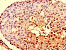 NOTCH3 Antibody - Immunohistochemistry of paraffin-embedded human breast cancer using NOTCH3 Antibody at dilution of 1:100