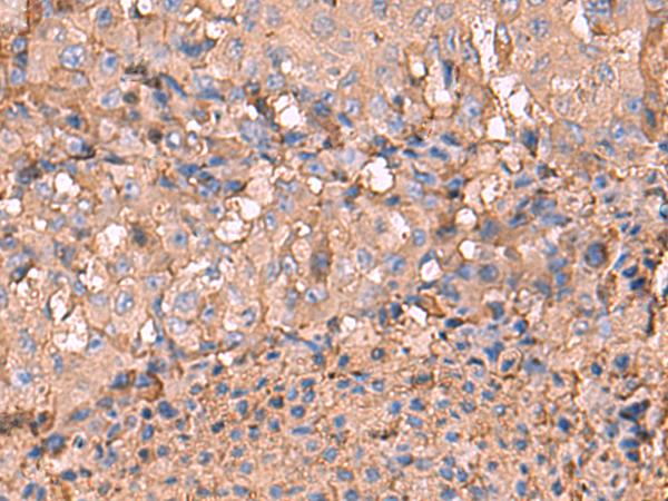 NOTCH4 Antibody - Immunohistochemistry of paraffin-embedded Human liver cancer tissue  using NOTCH4 Polyclonal Antibody at dilution of 1:30(×200)
