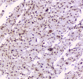 NOVA1 Antibody - IHC staining of FFPE human glioma with NOVA1 antibody at 1ug/ml. HIER: boil tissue sections in pH6, 10mM citrate buffer, for 10-20 min followed by cooling at RT for 20 min.