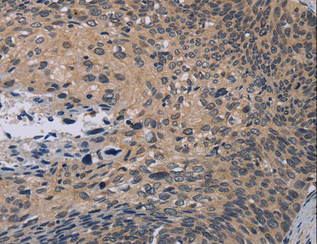 NOX1 Antibody - Immunohistochemistry of paraffin-embedded Human ovarian cancer using NOX1 Polyclonal Antibody at dilution of 1:50.