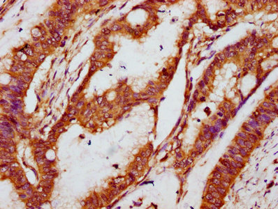 NOX1 Antibody - IHC image of NOX1 Antibody diluted at 1:100 and staining in paraffin-embedded human colon cancer performed on a Leica BondTM system. After dewaxing and hydration, antigen retrieval was mediated by high pressure in a citrate buffer (pH 6.0). Section was blocked with 10% normal goat serum 30min at RT. Then primary antibody (1% BSA) was incubated at 4°C overnight. The primary is detected by a biotinylated secondary antibody and visualized using an HRP conjugated SP system.