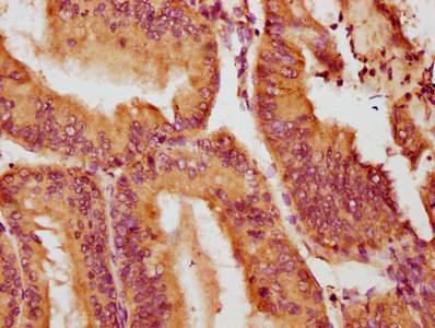 NOX1 Antibody - IHC image of NOX1 Antibody diluted at 1:100 and staining in paraffin-embedded human endometrial cancer performed on a Leica BondTM system. After dewaxing and hydration, antigen retrieval was mediated by high pressure in a citrate buffer (pH 6.0). Section was blocked with 10% normal goat serum 30min at RT. Then primary antibody (1% BSA) was incubated at 4°C overnight. The primary is detected by a biotinylated secondary antibody and visualized using an HRP conjugated SP system.