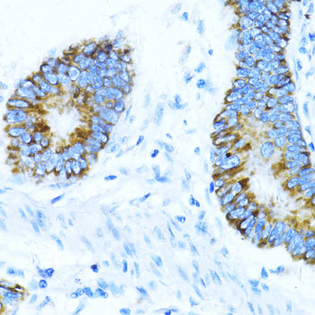 NOX1 Antibody - Immunohistochemistry of paraffin-embedded human colon carcinoma using NOX1 antibody at dilution of 1:100 (40x lens).