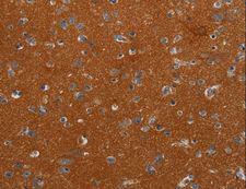 NOX3 Antibody - Immunohistochemistry of paraffin-embedded Human esophagus cancer using NOX3 Polyclonal Antibody at dilution of 1:40.