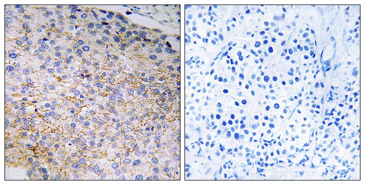 NOX3 Antibody - Peptide - + Immunohistochemistry analysis of paraffin-embedded human breast carcinoma tissue using NOX3 antibody.