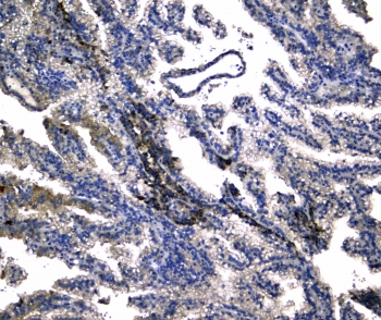 NOX4 Antibody - IHC testing of FFPE human renal cancer tissue with NADPH oxidase 4 antibody at 1ug/ml. Required HIER: steam section in pH6 citrate buffer for 20 min and allow to cool prior to staining.