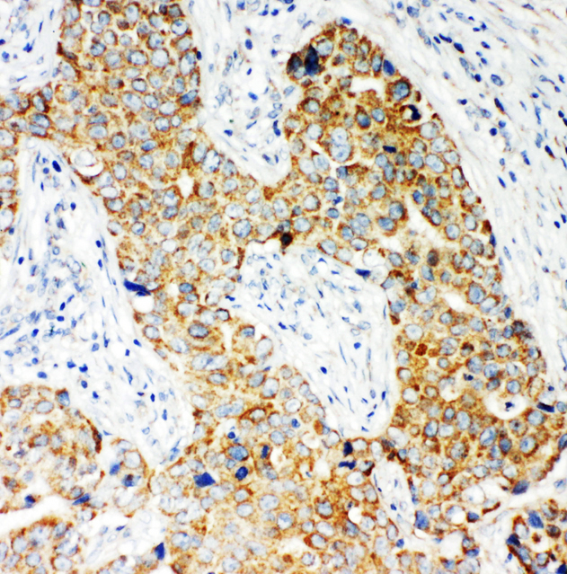 NOX5 Antibody - NOX5 antibody. IHC(P): Human Breast Cancer Tissue.