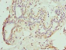NOX5 Antibody - Immunohistochemistry of paraffin-embedded human breast cancer tissue at dilution 1:100
