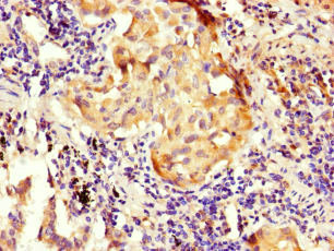 NOXA1 Antibody - Immunohistochemistry of paraffin-embedded human lung cancer at dilution of 1:100