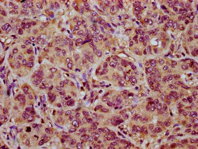 NOXO1 Antibody - Immunohistochemistry Dilution at 1:200 and staining in paraffin-embedded human liver cancer performed on a Leica BondTM system. After dewaxing and hydration, antigen retrieval was mediated by high pressure in a citrate buffer (pH 6.0). Section was blocked with 10% normal Goat serum 30min at RT. Then primary antibody (1% BSA) was incubated at 4°C overnight. The primary is detected by a biotinylated Secondary antibody and visualized using an HRP conjugated SP system.