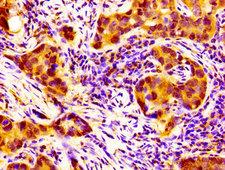 NPAS2 Antibody - Immunohistochemistry image at a dilution of 1:100 and staining in paraffin-embedded human pancreatic cancer performed on a Leica BondTM system. After dewaxing and hydration, antigen retrieval was mediated by high pressure in a citrate buffer (pH 6.0) . Section was blocked with 10% normal goat serum 30min at RT. Then primary antibody (1% BSA) was incubated at 4 °C overnight. The primary is detected by a biotinylated secondary antibody and visualized using an HRP conjugated SP system.