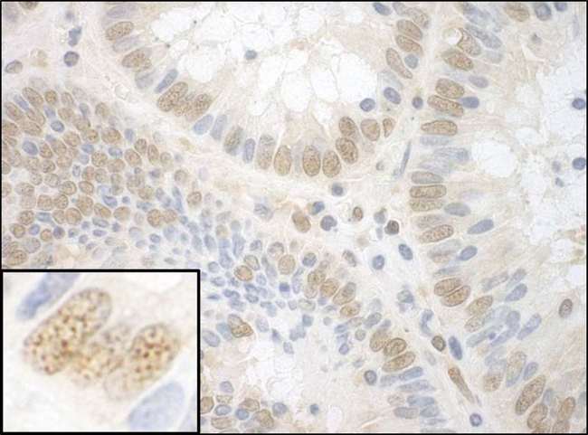 NPAT Antibody - Detection of Human NPAT by Immunohistochemistry. Sample: FFPE section of human colon carcinoma. Antibody: Affinity purified rabbit anti-NPAT used at a dilution of 1:1000 (1 Detection: DAB.