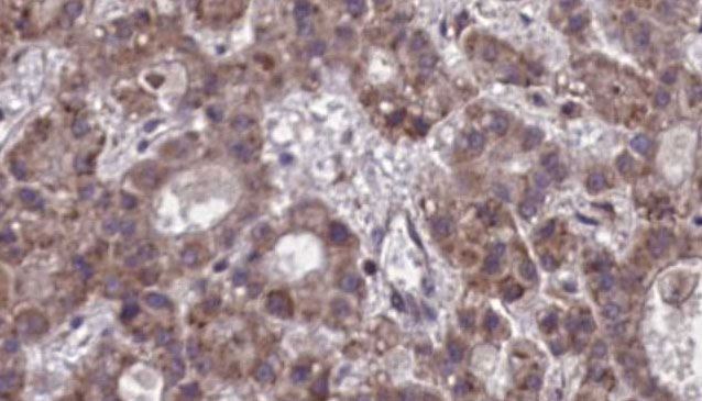 NPBWR1 / GPR7 Antibody - 1:100 staining human liver carcinoma tissues by IHC-P. The sample was formaldehyde fixed and a heat mediated antigen retrieval step in citrate buffer was performed. The sample was then blocked and incubated with the antibody for 1.5 hours at 22°C. An HRP conjugated goat anti-rabbit antibody was used as the secondary.