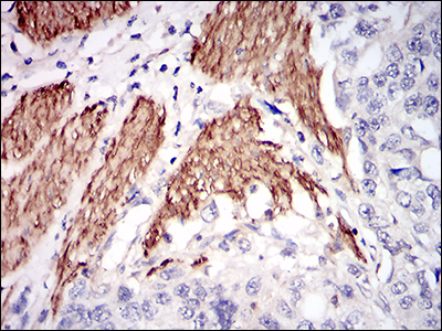 NPC / NPC1 Antibody - IHC of paraffin-embedded esophageal cancer tissues using NPC1 mouse monoclonal antibody with DAB staining.