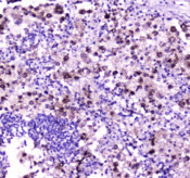NPC2 Antibody - IHC testing of FFPE human lung cancer tissue with NPC2 antibody at 1ug/ml. Required HIER: steam section in pH6 citrate buffer for 20 min and allow to cool prior to staining.