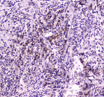 NPC2 Antibody - IHC testing of FFPE human intestine cancer tissue with NPC2 antibody at 1ug/ml. Required HIER: steam section in pH6 citrate buffer for 20 min and allow to cool prior to staining.