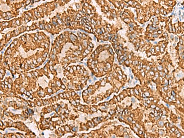 NPC2 Antibody - Immunohistochemistry of paraffin-embedded Human thyroid cancer tissue  using NPC2 Polyclonal Antibody at dilution of 1:80(×200)