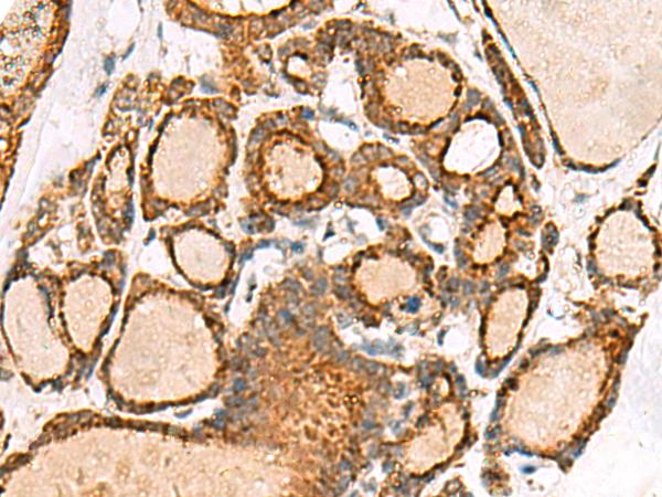 NPC2 Antibody - Immunohistochemistry of paraffin-embedded Human thyroid cancer tissue  using NPC2 Polyclonal Antibody at dilution of 1:50(×200)