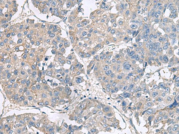 NPHP1 / Nephronophthisis Antibody - Immunohistochemistry of paraffin-embedded Human liver cancer tissue  using NPHP1 Polyclonal Antibody at dilution of 1:75(×200)