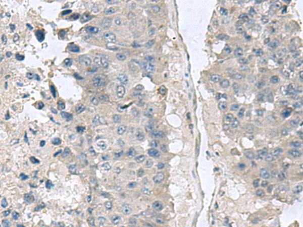 NPHP1 / Nephronophthisis Antibody - Immunohistochemistry of paraffin-embedded Human liver cancer tissue  using NPHP1 Polyclonal Antibody at dilution of 1:60(×200)