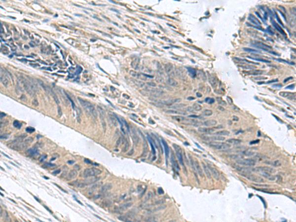 NPHP1 / Nephronophthisis Antibody - Immunohistochemistry of paraffin-embedded Human colorectal cancer tissue  using NPHP1 Polyclonal Antibody at dilution of 1:60(×200)
