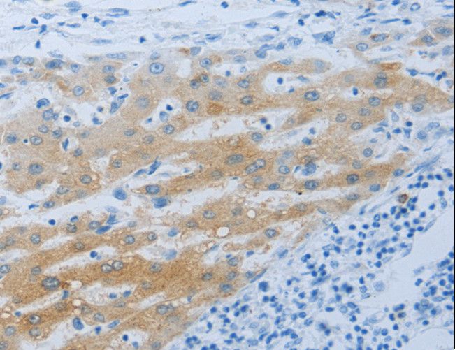 NPHS1 / Nephrin Antibody - Immunohistochemistry of paraffin-embedded Human liver cancer using NPHS1 Polyclonal Antibody at dilution of 1:50.